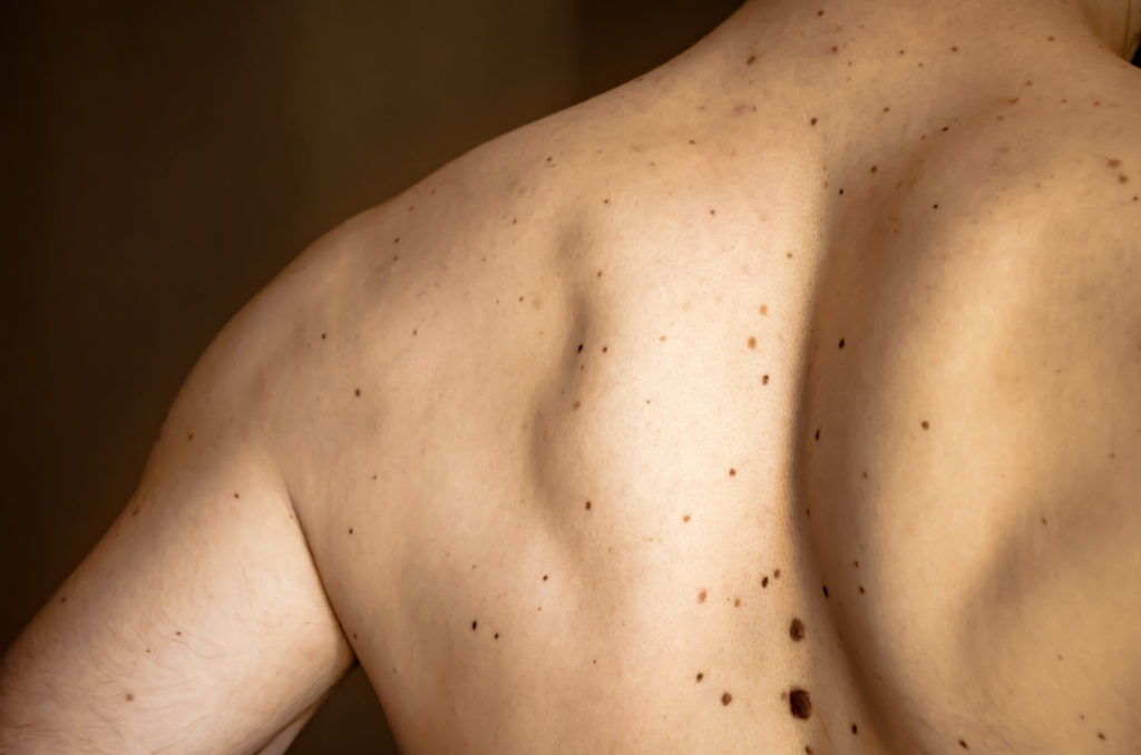 Many moles on the back of a young man. Check benign moles. The effect of the sun on the skin. The concept of health. Close up.