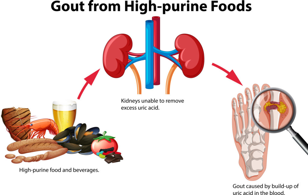 Gout from High-purine Foods illustration