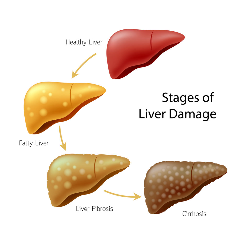 Healthy liver, fatty liver, liver fibrosis and Cirrhosis. Illustration info-graphic, isolated on white background.
