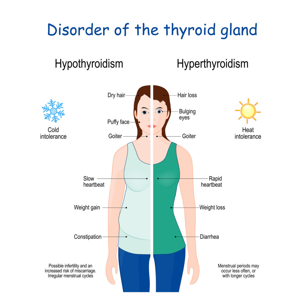 Hyperthyroidism and Hypothyroidism comparisons. disorders of the endocrine system. Female with Signs and symptoms of different thyroid gland diseases